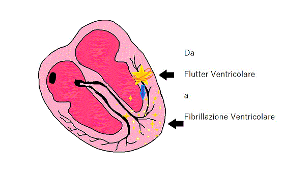 Le principali aritmie cardiache al tracciato Ecg spiegate ...