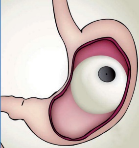 Bioenterics Intragastric Balloon BIB fonte sicob.org