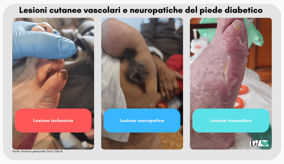 Lesioni cutanee del piede diabetico neuropatico e ischemico