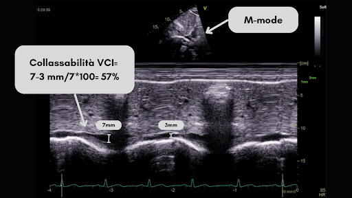 Calcolo della di collassabilita della VCI tramite M mode. Immagini di archivio Dario Tobruk © modificato tramite Canva.com versione Pro