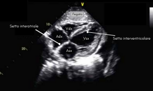 Proiezione  ecocardiografica 4 camere sottocostale. Archivio Dario Tobruk ©