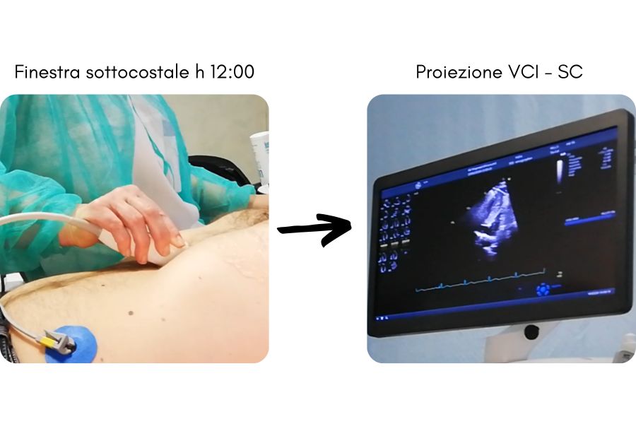 Proiezione ecografica della vena cava inferiore. Immagini di Archivio Dario Tobruk © modificato tramite Canva.com versione Pro